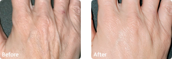 Cosmetic treatment for hands before and after