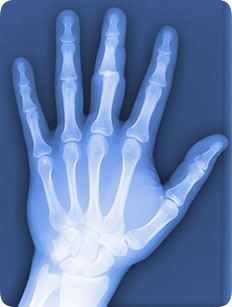 Xray of a disclocated finger