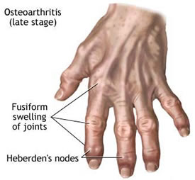 Finger Pain, Possible Causes, Arthritis, & Treatment