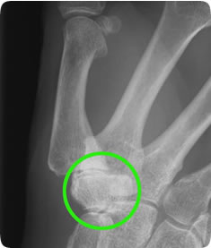 Xray of arthritis