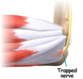 Cubital tunnel syndrome diagram