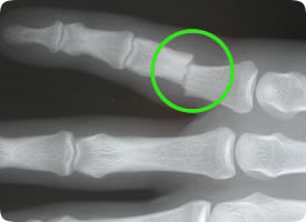 Xray of finger fracture