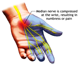 Picture of carpal tunnel syndrome