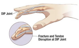 Mallet finger diagram