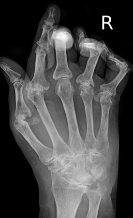 Xray of arthritis