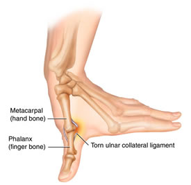 Diagram of skiers thumb