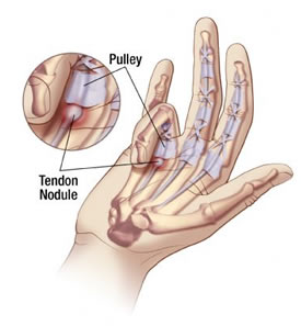 Trigger finger diagram